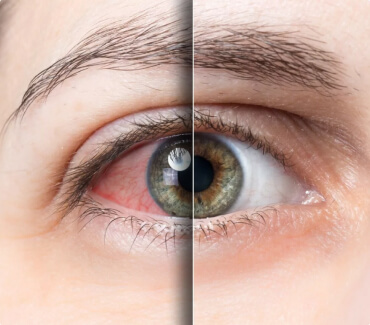 Синдром «сухого глаза»: индивидуальная особенность или общемировая проблема?
